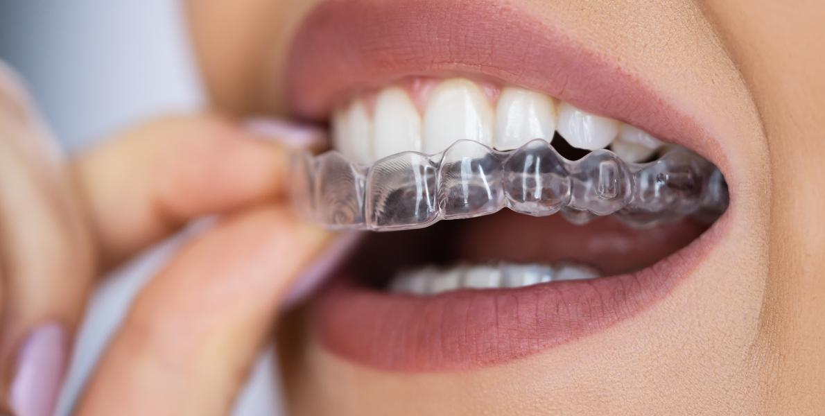 Why Aligner Treatment Should Only Be Done by Orthodontists