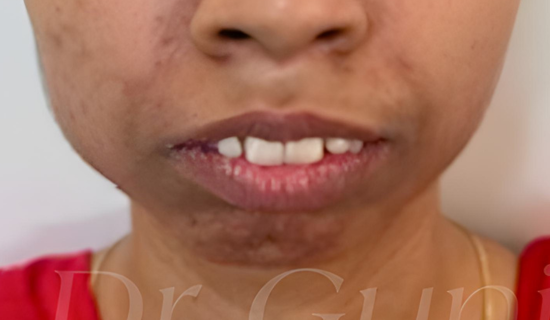 Clear Aligners Powai