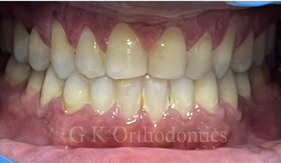 Invisible Braces in Chandivali
