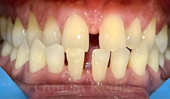 Invisible Braces in Andheri