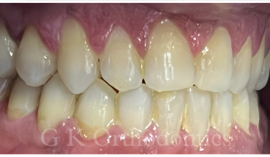 Invisible Braces in Hiranandani, Powai