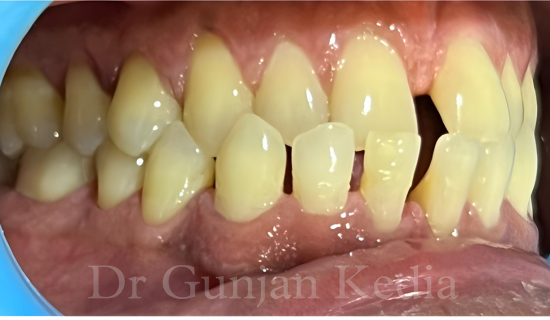 Invisible Braces in Powai