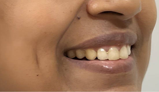 Invisalign Adults after