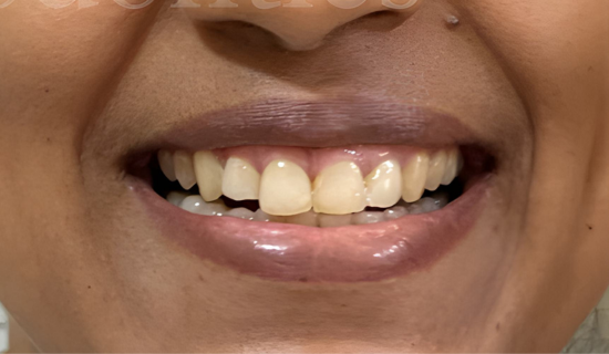 Invisalign Adults after
