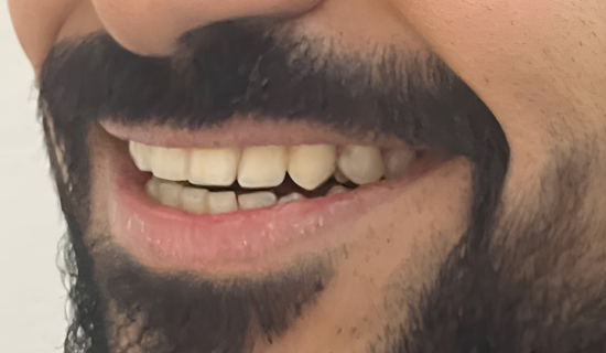 Invisalign for Adults in Powai