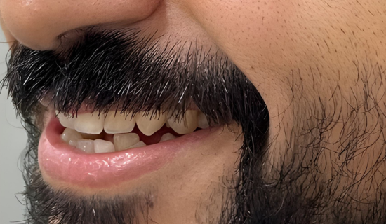 Invisalign Provider Powai