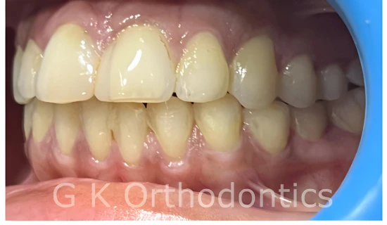 Best Dentist for Braces in Powai