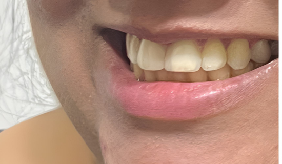 Best Invisalign Doctor in Chandivali