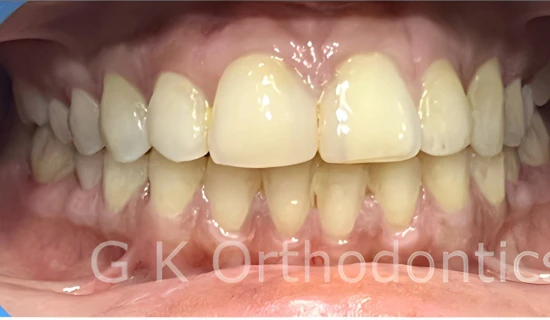 Best Dentist for Braces in Powai