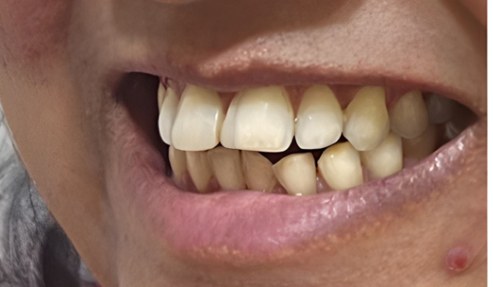 Best Invisalign Doctor in Chandivali
