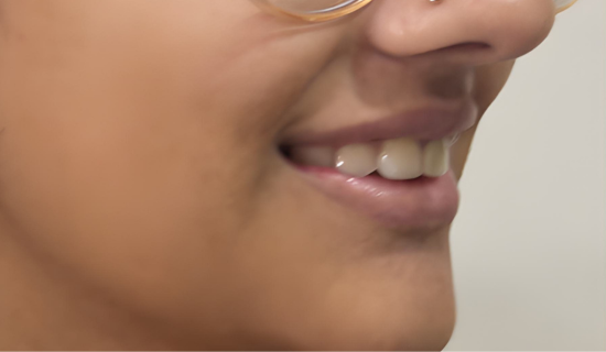 Kids Invisalign