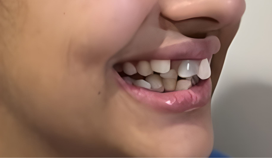 Kids Invisalign