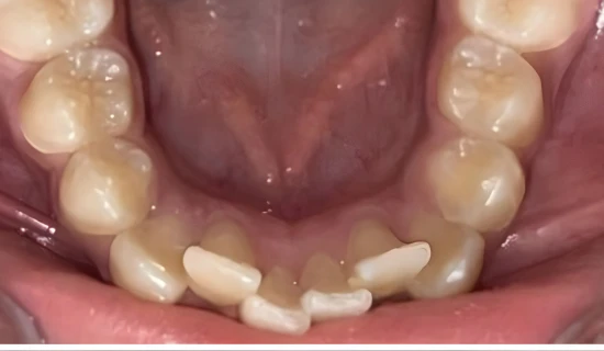 Kids Invisalign