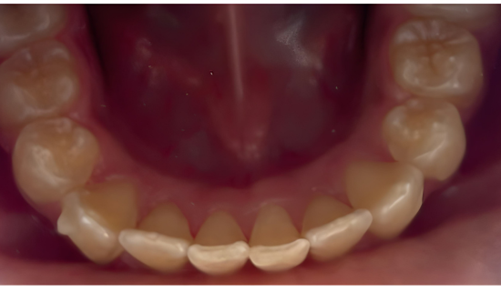 Kids Invisalign