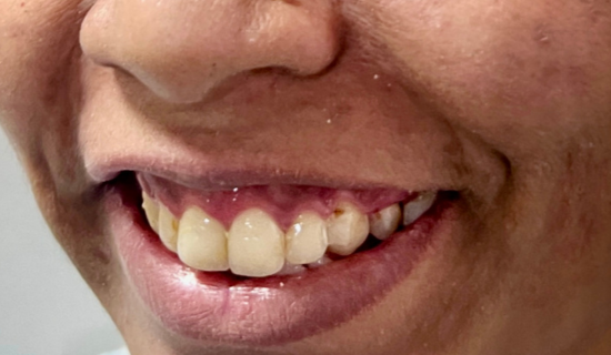 Clear Aligners Hiranandani, Powai