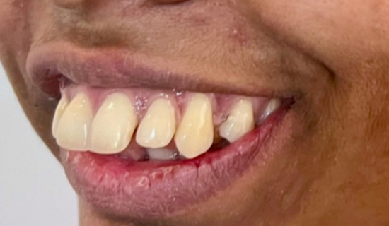 Clear Aligners Chandivali
