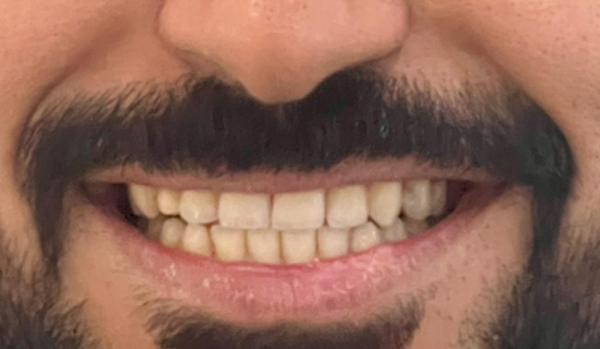 Invisalign Provider Chandivali