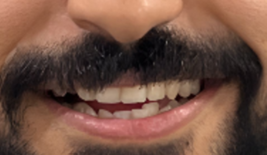Invisalign Provider Andheri - Invisalign dental crowding correction