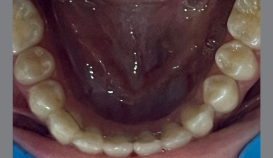 Invisalign Teen Powai
