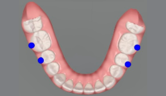 Invisalign Teen Powai