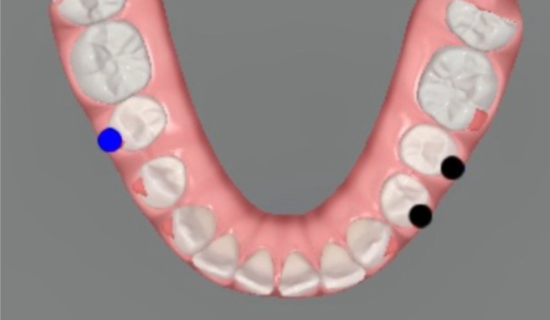 Invisalign Teen Powai