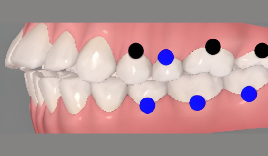 Invisalign : Open Bite Correction