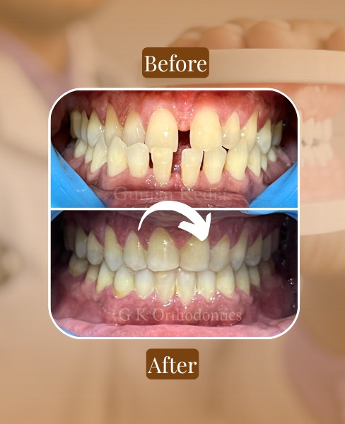 Best Orthodontist in Andheri, Powai for Invisalign, aligners