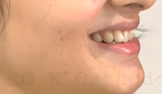 smile makeover