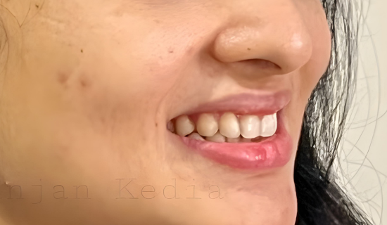 smile makeover