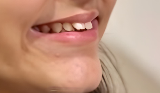 Teen Invisalign