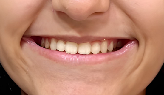 Teen Invisalign