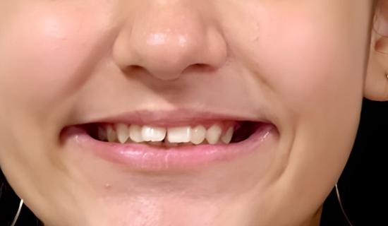 Teen Invisalign