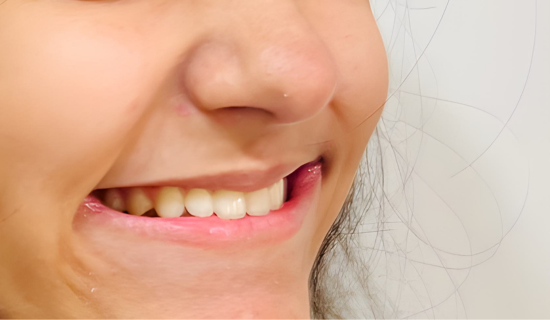 Teen Invisalign