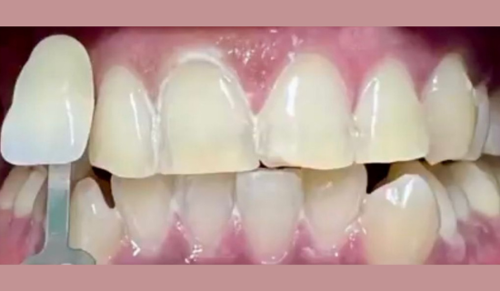 Teeth whitening