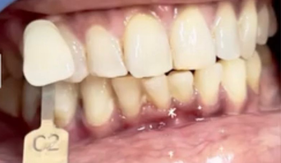 Teeth whitening