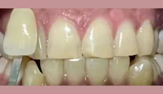 Teeth Whitening