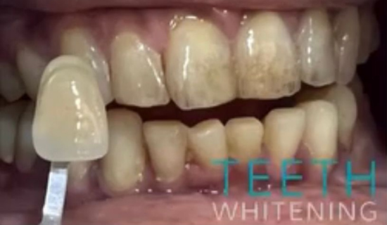 Teeth Whitening