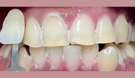 Teeth Whitening Near Hiranandani, Powai