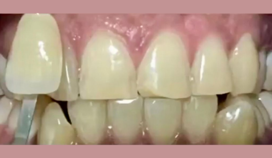 Teeth Whitening Near Hiranandani, Powai