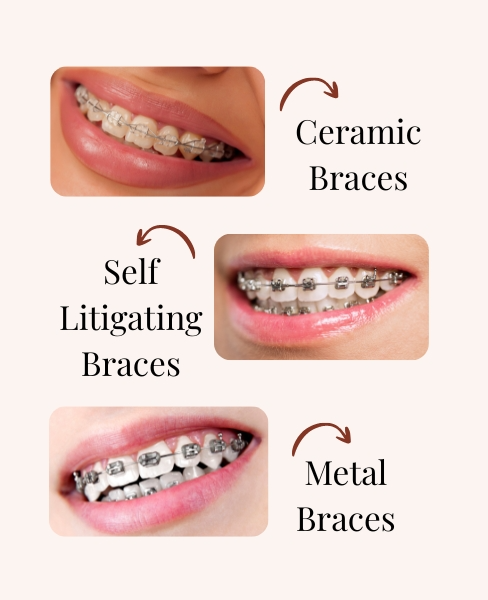Best Dentist for Braces in Powai - Dr Gunjan Kedia