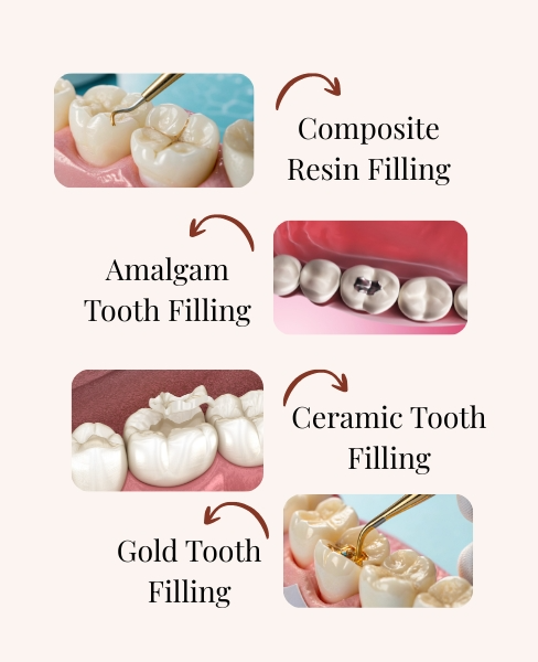 Types of tooth filling