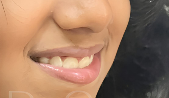 Invisalign for Kids Powai