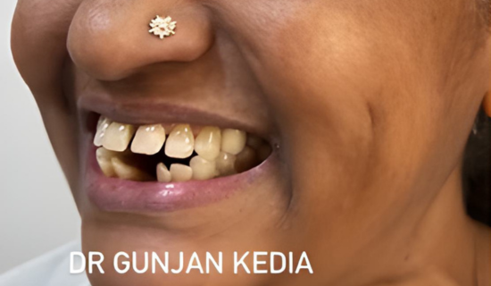 Invisalign for Adults