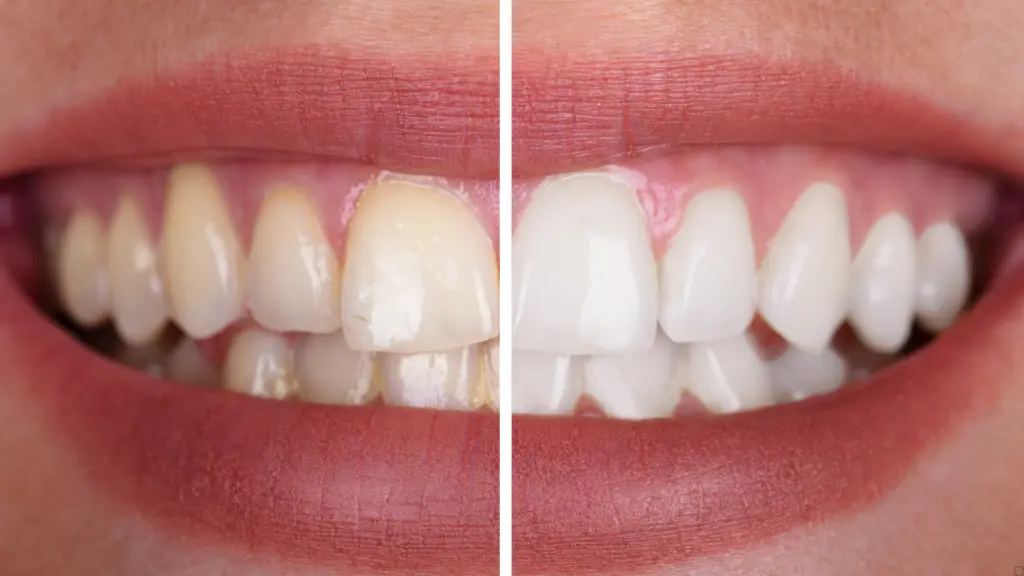 Teeth cleaning specialist Powai