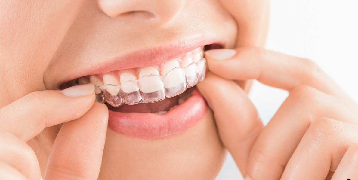 Invisalign Underbite